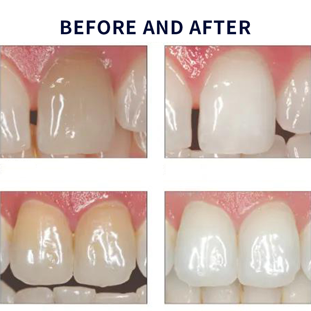 Opalescence Whitening 20% PF 2 - Teeth Whitening Q&M 评论和价格