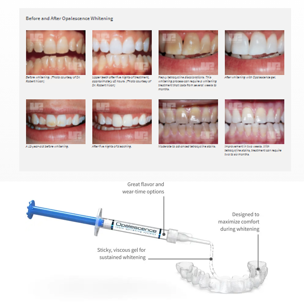 Opalescence Whitening 20% PF 2 - Teeth Whitening Q&M 评论和价格