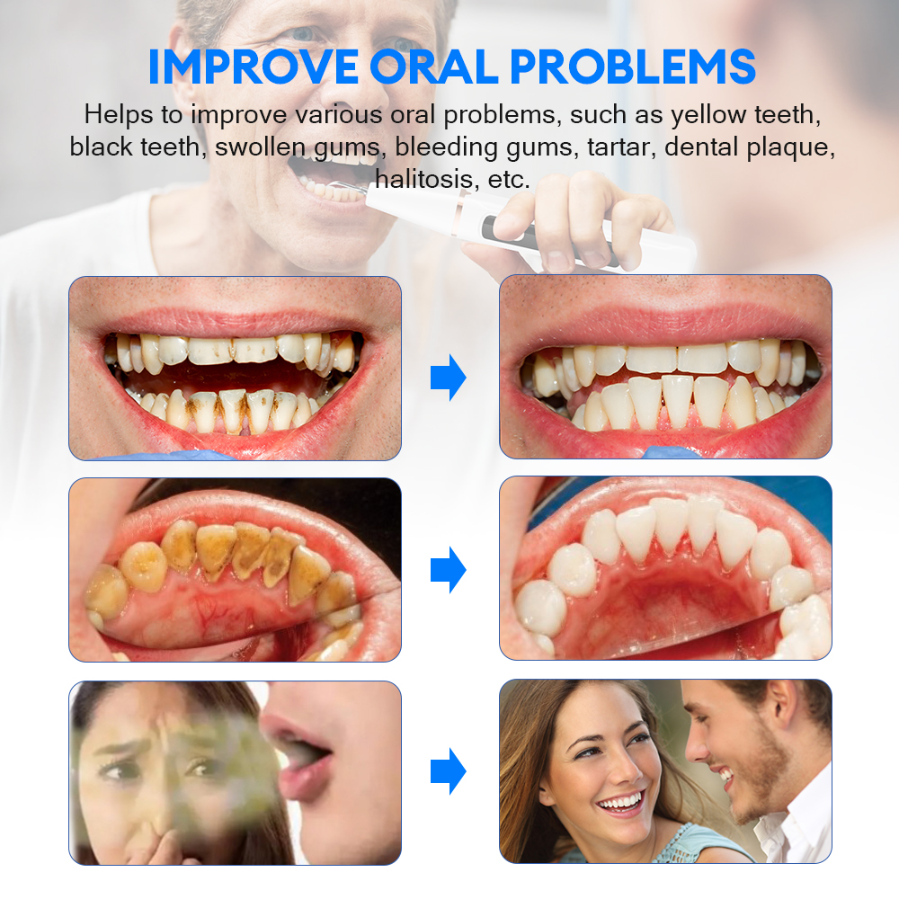 Electric Ultrasonic Dental Sca - Teeth Whitening And Stain Removal 评论和价格