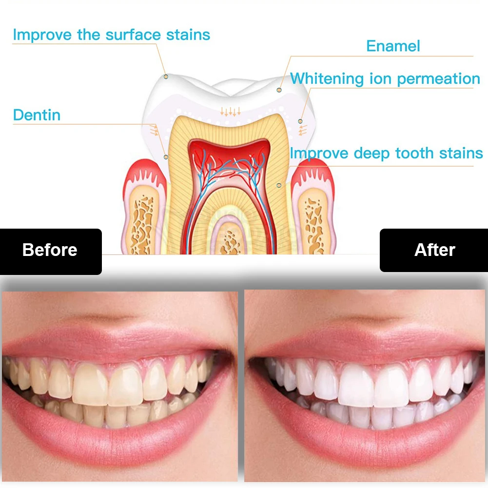 Dental Teeth Whitening Kit Min - Teeth Whitening Q&M 评论和价格