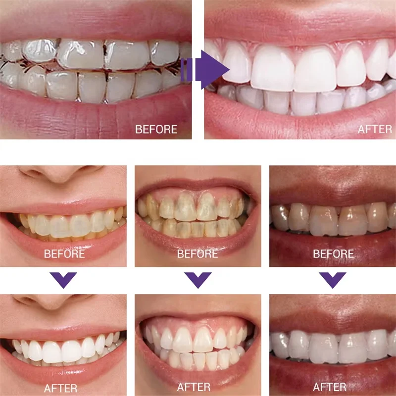 Whitening Toothpaste Teeth Cle - Teeth Whitening Korea 评论和价格